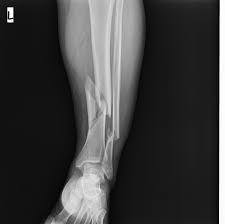 Tibia Kırıkları Tedavisi