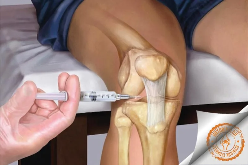 EKLEM İÇİ ENJEKSİYONLAR Tedavisi