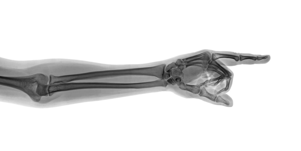 humerus kırıkları